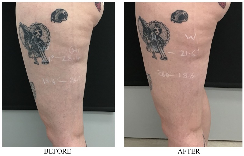 Radiofrequency For Cellulite & Fat Information